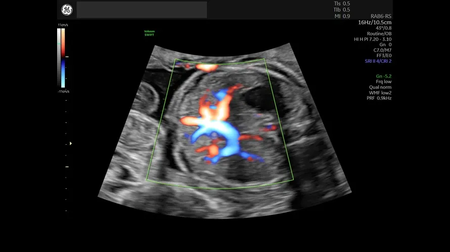 Flow Profiles Doppler optimisation